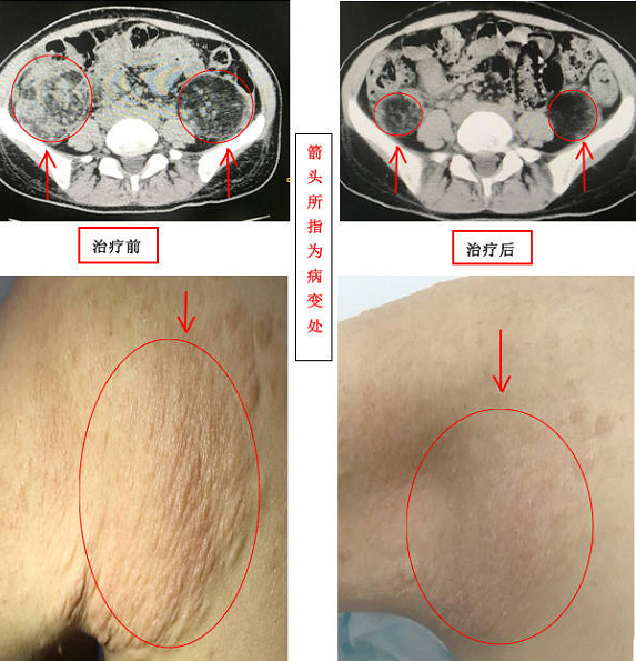 孕妈肚子里长了两个大瘤子生的小宝宝也中招了