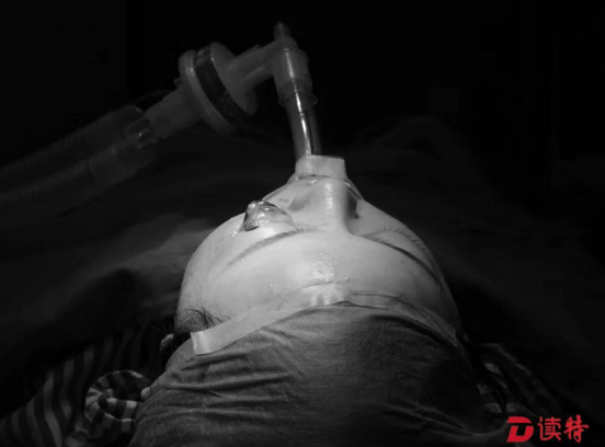 眼球掉出来还能种回去这位21岁女子真幸运