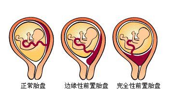 孕妇前置胎盘引产不用挨刀,只因宝安这家医院