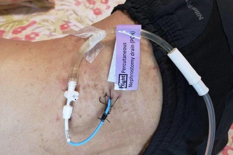 尿管的人比如说而是需要长期卧床养病的人我们鼓励的不是精神萎靡的"