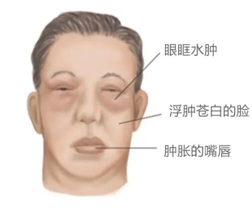 暗藏着不同的信息不同部位水肿或者是身体代谢水平出现了问题往往是