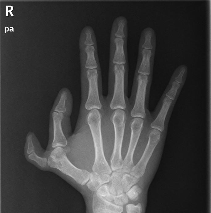 术前外观3,骨关节相连多指:复杂的多指畸形手术