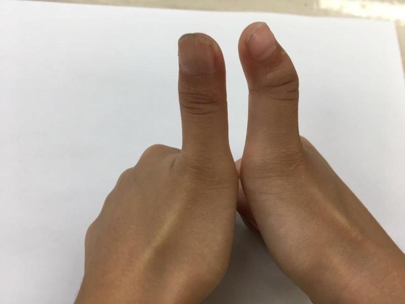 多指畸形的宝宝,愿你以后被世界温柔以待_深圳新闻网