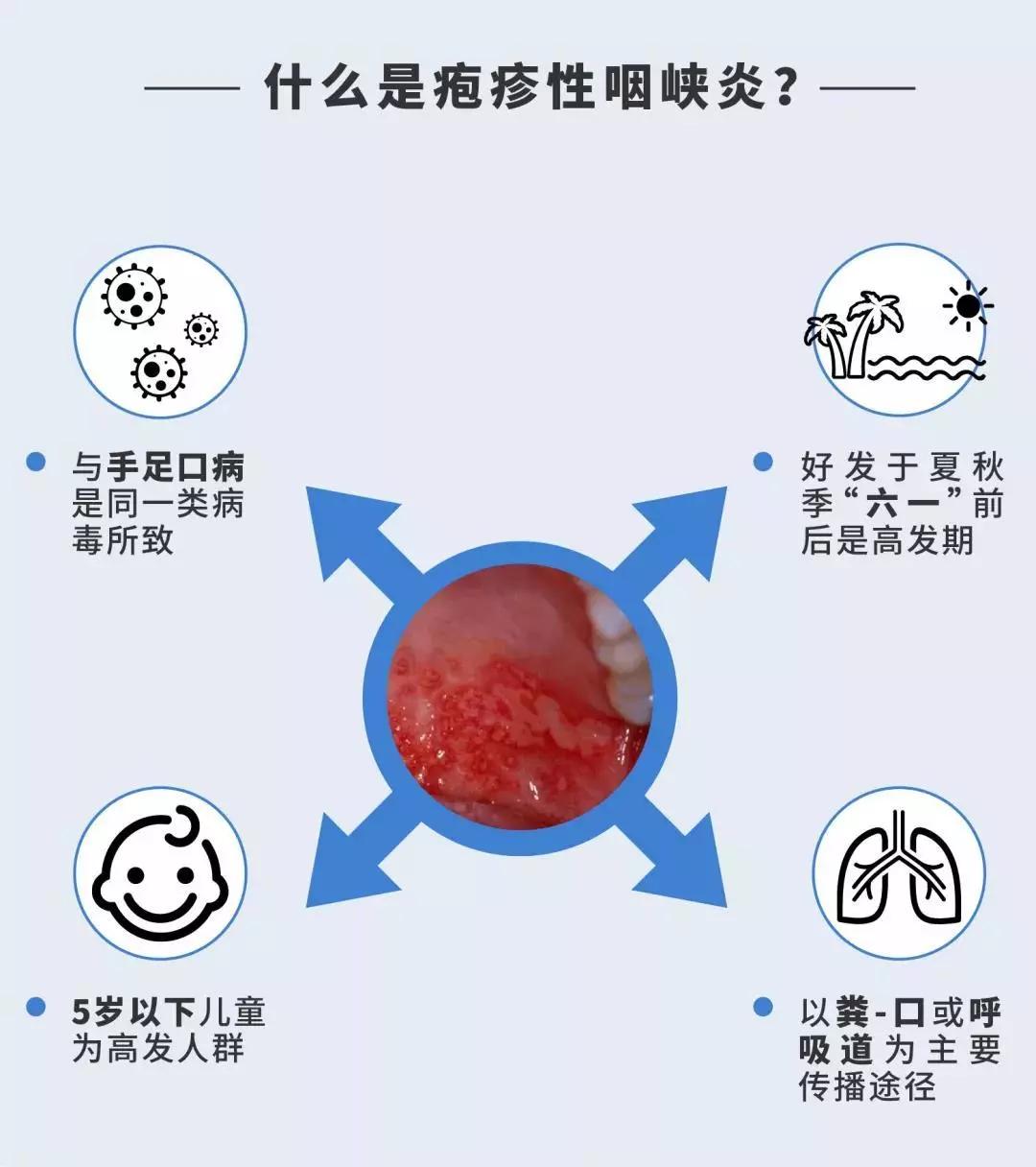 符合以下3点即可临床诊断为疱疹性咽峡炎01急性起病02突发咽痛和发热