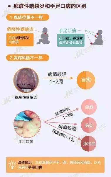爱传染孩子的疱疹性咽峡炎来袭发病率激增
