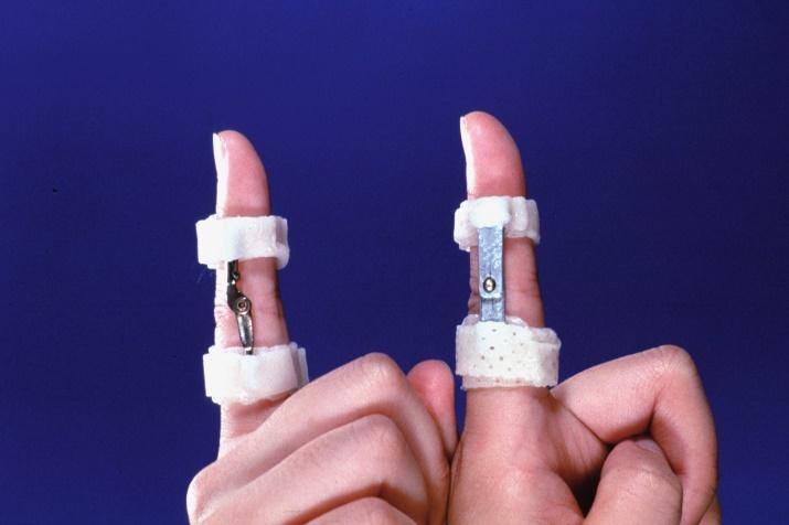 手术后的固定及治疗手指关节渐进性屈曲拉伸支具⑧肢体软组织急性炎症