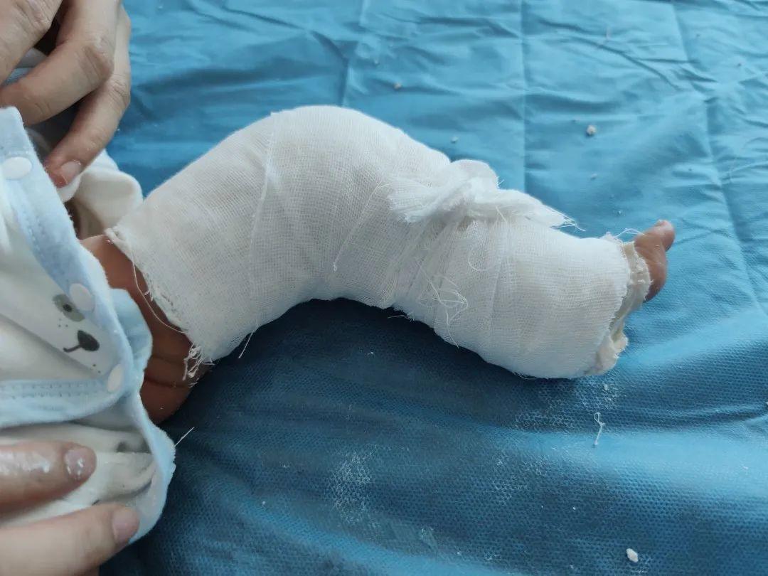 "左侧膝关节反曲畸形,被动曲屈严重受限,这是先天性膝关节完全脱位