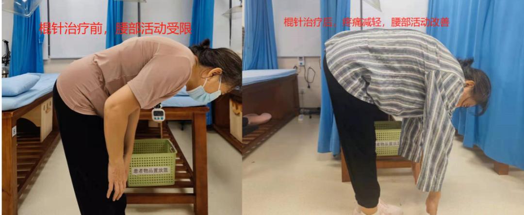 罗医集团罗湖中医院治未病科最新开展项目：“棍针拨筋疗法” | 治疗这些病，它有奇效~_深圳新闻网