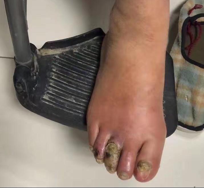 因为同样的症状7年前左腿截肢现在右腿还能保住吗