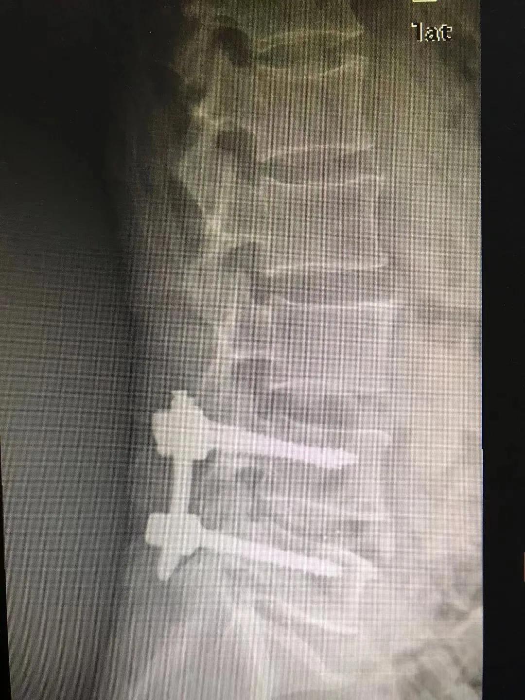 腰椎间盘突出已经成为打工人标配了