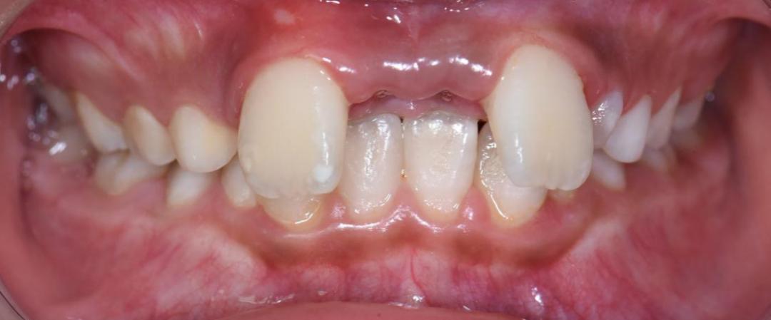 多生牙是什么?它有什么危害?趁着放暑长假,不如来正牙吧!