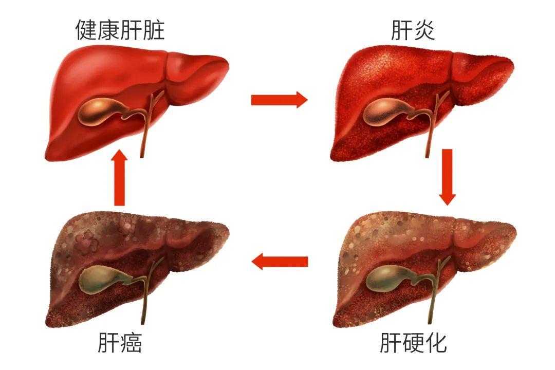 肝病义诊这些慢性肝病快来免费筛查