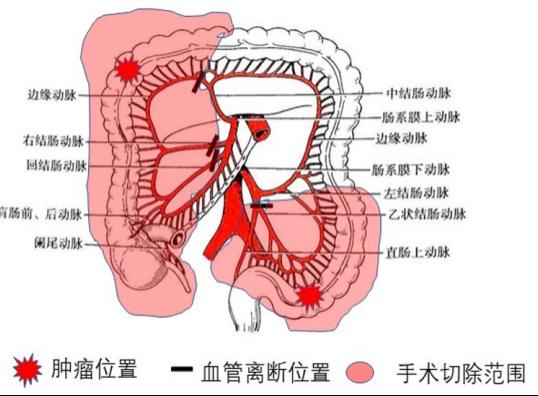 成功将两处肿瘤根治性切除,同时保留左半结肠进行两处吻合