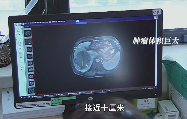 71岁大爷,体检查出肝脏阴影,拖了1年,肿瘤长到拳头大