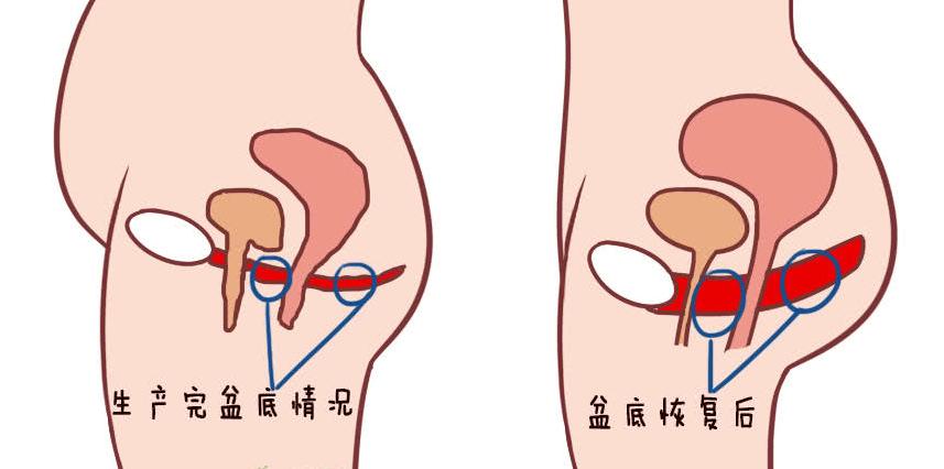 盆底肌我松了你性福没了