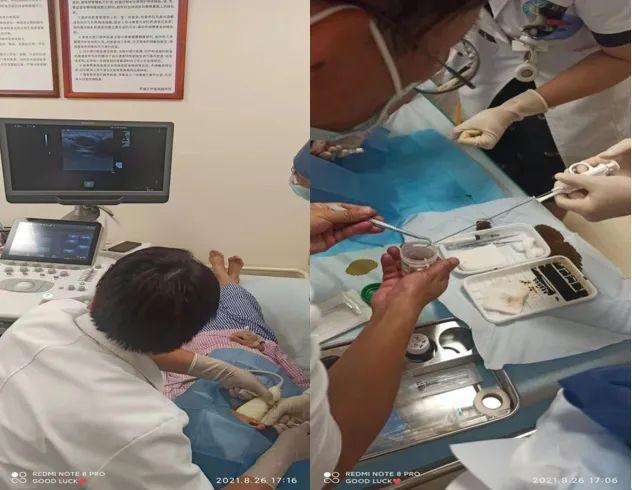 通过骨髓涂片,医务人员快速得出诊断结果,仅提示骨髓增生活跃.