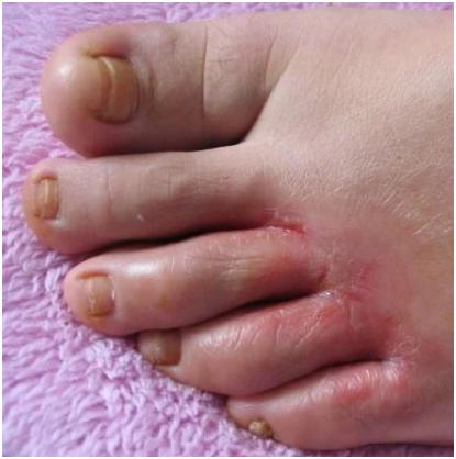 一般多发于第3,4趾间和第4,5趾间,初期脚趾潮湿,有小水疱或是浸渍发白