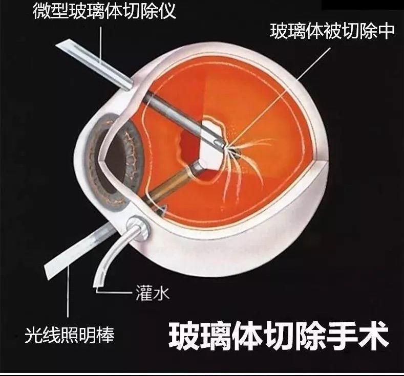 眼睛出现这些信号要小心|深圳市龙华区中心医院眼科成功开展玻璃体