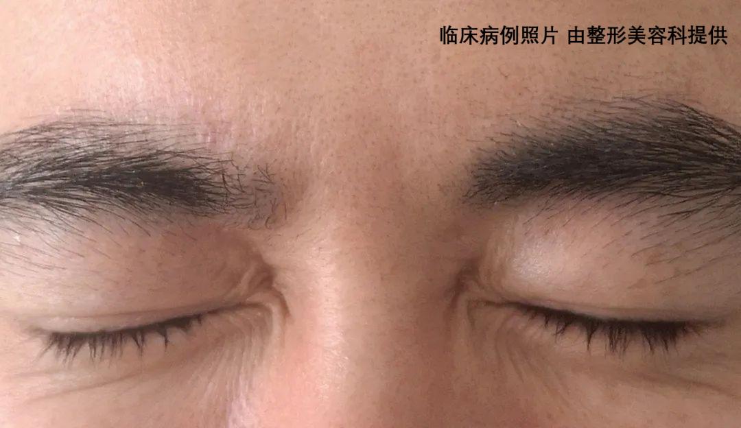 眉间横纹治疗前额部抬头纹治疗后额部抬头纹治疗前72疗效观察:一般1