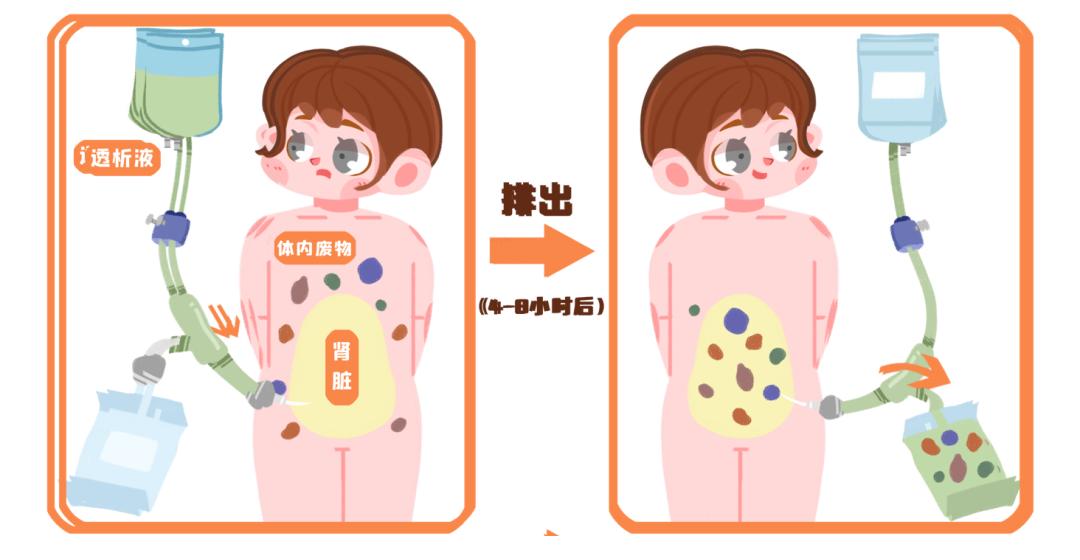 通过弥散,超滤等物理原理,将体内的代谢废物和多余水分排进腹透液中