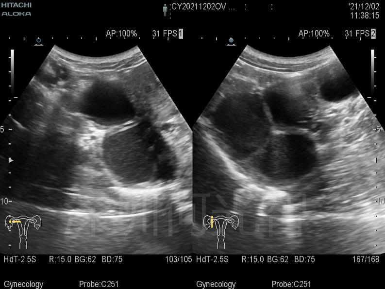 又是巧囊多个最大5公分手术方式该如何选择