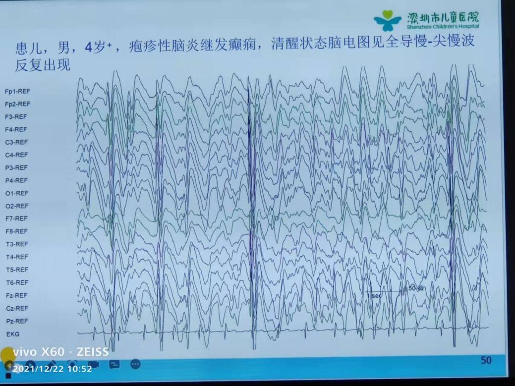 聆听专家授课——儿童神经疾病篇《脑电图检测技术与应用》培训