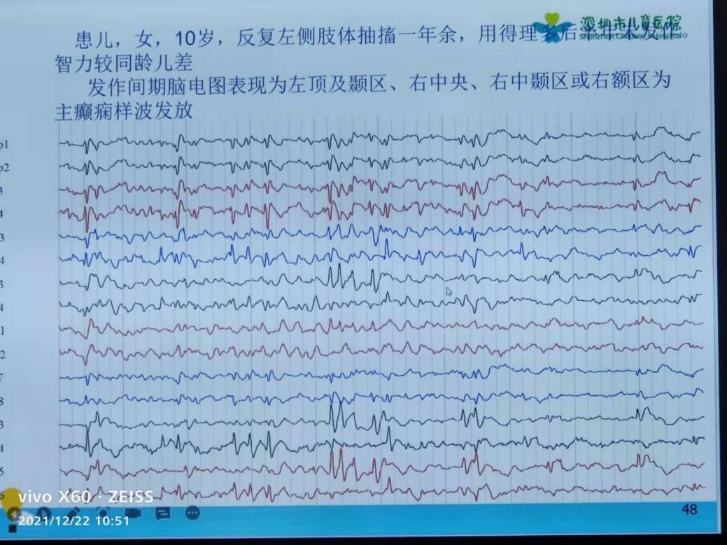 聆听专家授课——儿童神经疾病篇《脑电图检测技术与应用》培训