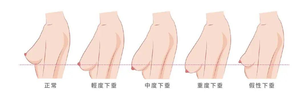 乳房下垂分度:76通常女性尤其是年轻女性的乳房乳头的水平应在乳房