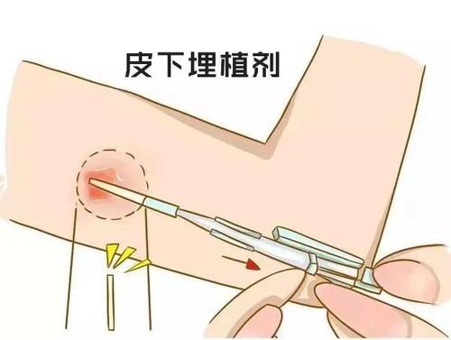图片来源:网络07长效避孕针类型:激素制剂.