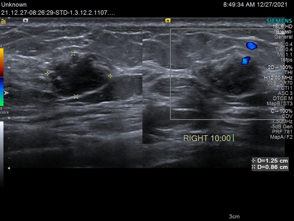 这是非常典型的乳腺癌超声影像,我们考虑为右乳癌.