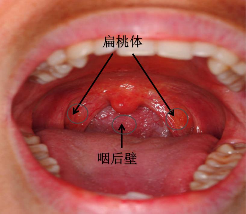 正常人的咽后壁图片图片